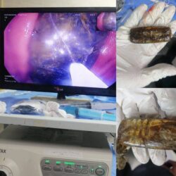 نجاح عملية استخراج هاتف من معدة مريض بمستشفى الأزهر بأسيوط .