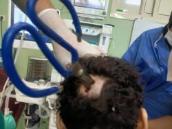 تأمين صحي  بنها ينجح في إنقاذ حياة مريض باستخراج مقص حديدي من الجمجمة. 