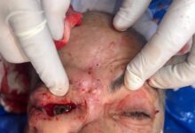 فريق طبي بمستشفيات سوهاج الجامعية ينجح في إجراء جراحة دقيقة لاستئصال ورم سرطاني خبيث بالعين