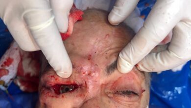 فريق طبي بمستشفيات سوهاج الجامعية ينجح في إجراء جراحة دقيقة لاستئصال ورم سرطاني خبيث بالعين