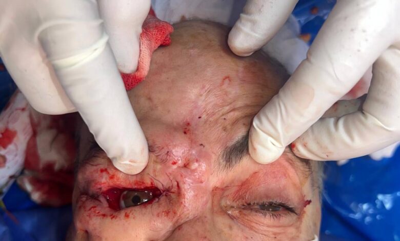 فريق طبي بمستشفيات سوهاج الجامعية ينجح في إجراء جراحة دقيقة لاستئصال ورم سرطاني خبيث بالعين