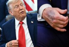 كدمة واضحة على يد ترامب اليسرى تثير تكهنات صحية