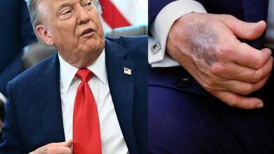 كدمة واضحة على يد ترامب اليسرى تثير تكهنات صحية