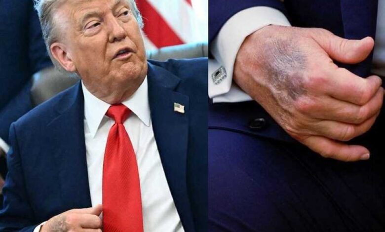كدمة واضحة على يد ترامب اليسرى تثير تكهنات صحية