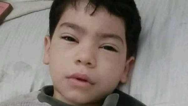 تطورات الحالة الصحية لطفل باسوس المصاب بطلق خرطوش في القليوبية 